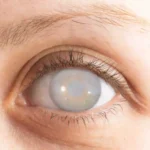 Posterior Capsular Opacification – Causes, Symptoms, and Treatment