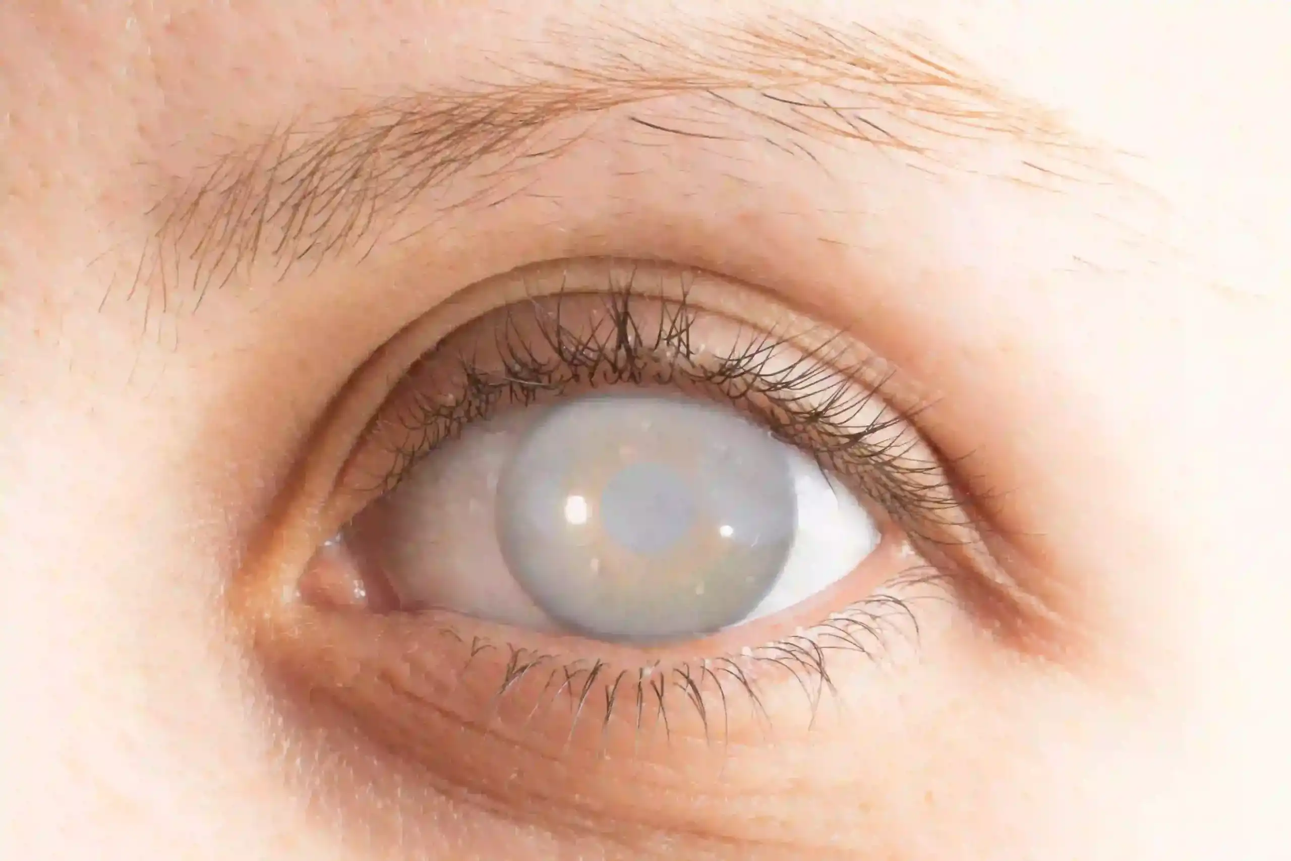 Posterior Capsular Opacification – Causes, Symptoms, and Treatment