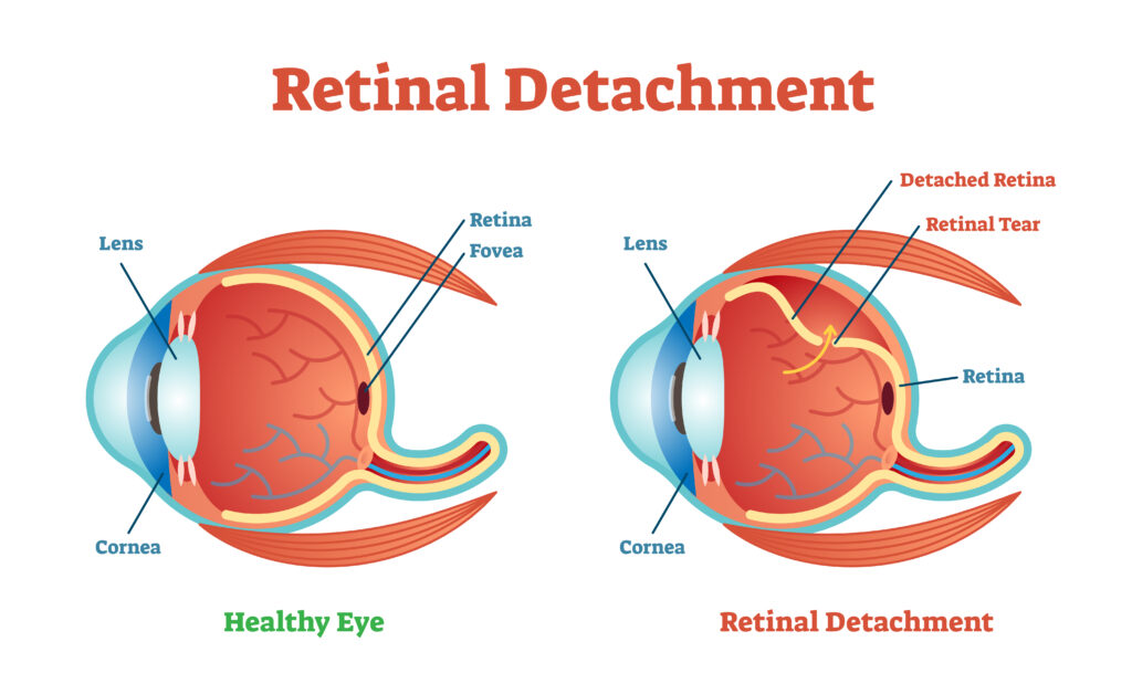 Retinal Detachment: Signs, Emergency Response, and Recovery Process