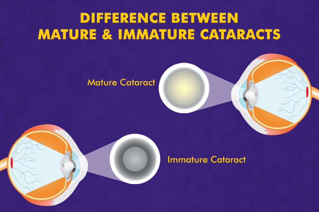 Difference Between Mature and Immature Cataract