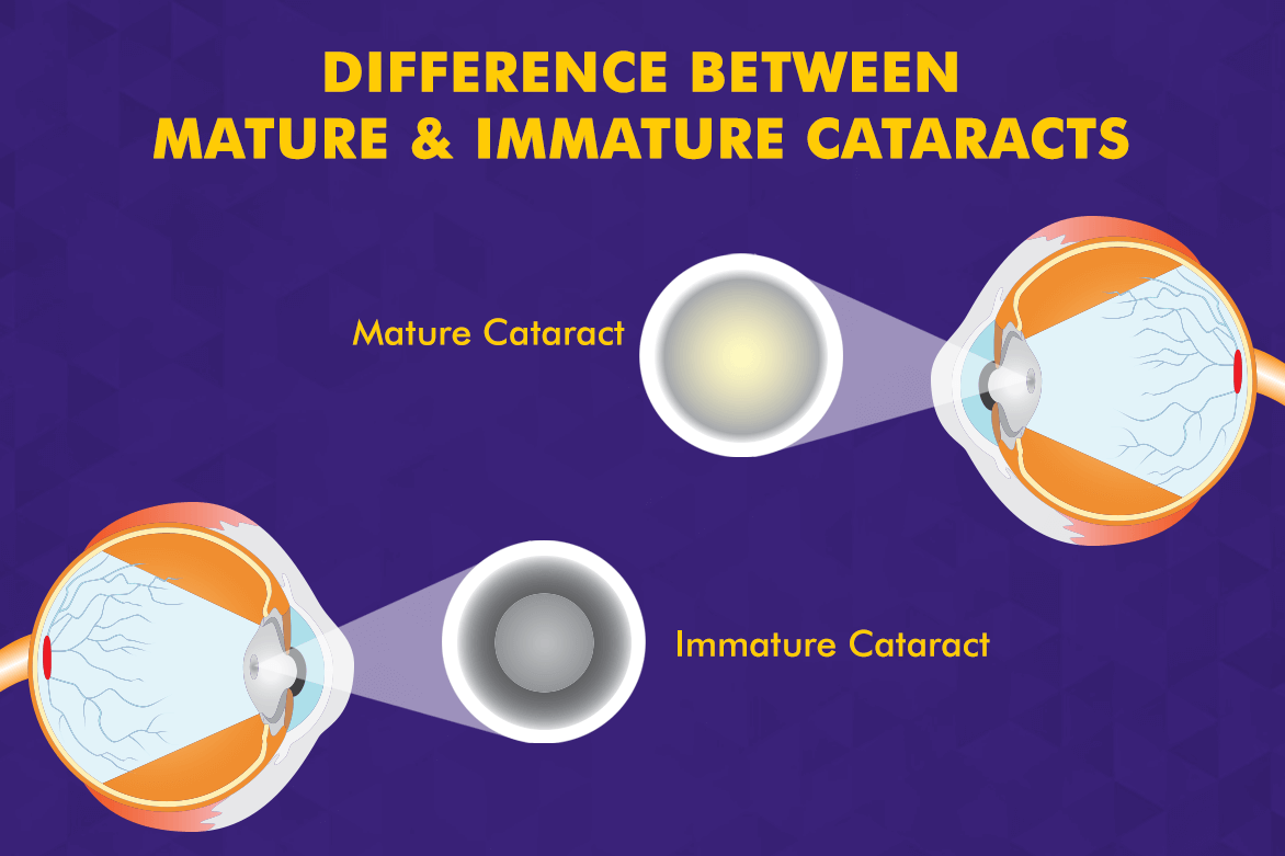 Differences Between Mature and Immature Cataract
