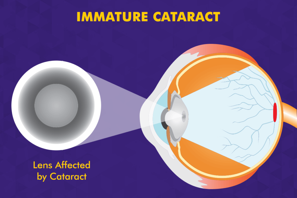Immature Cataract
