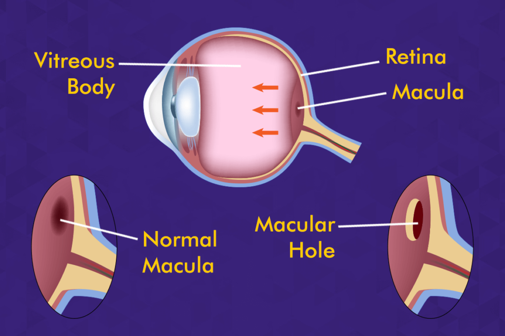 Macular Hole: Symptoms, Causes and Treatments