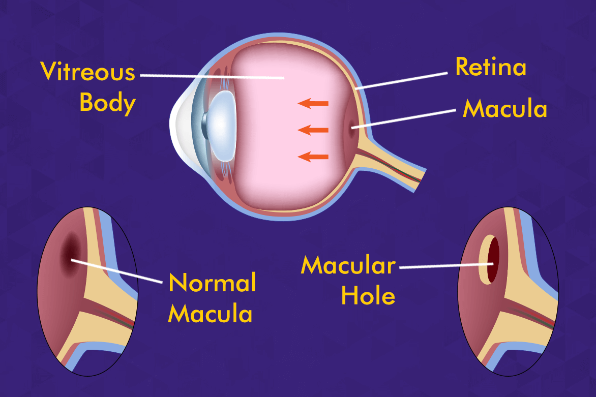 Macular Hole(Retinal Hole)