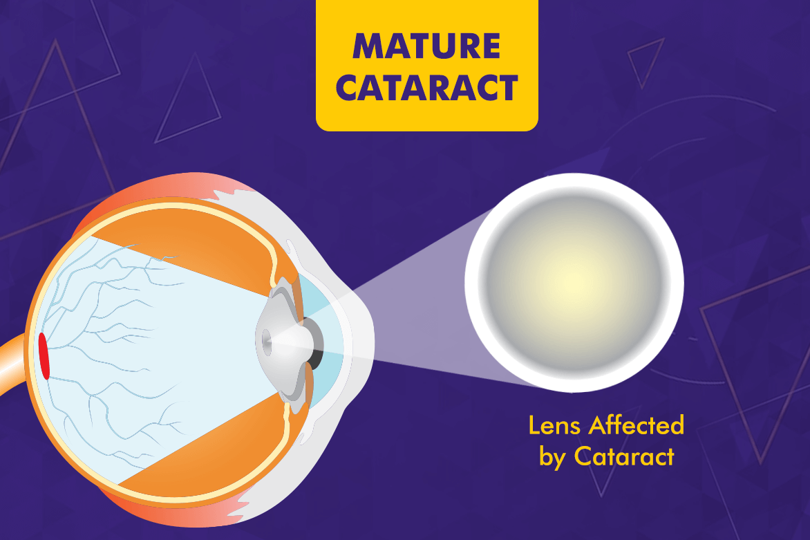 Mmature Cataract