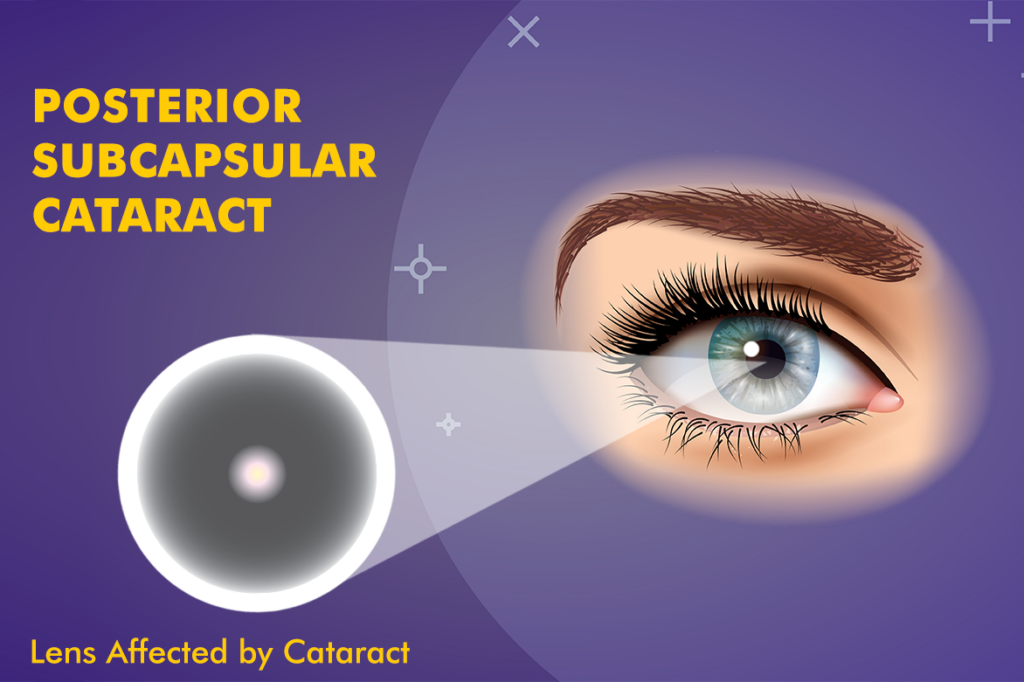 Posterior Subcapsular Cataract