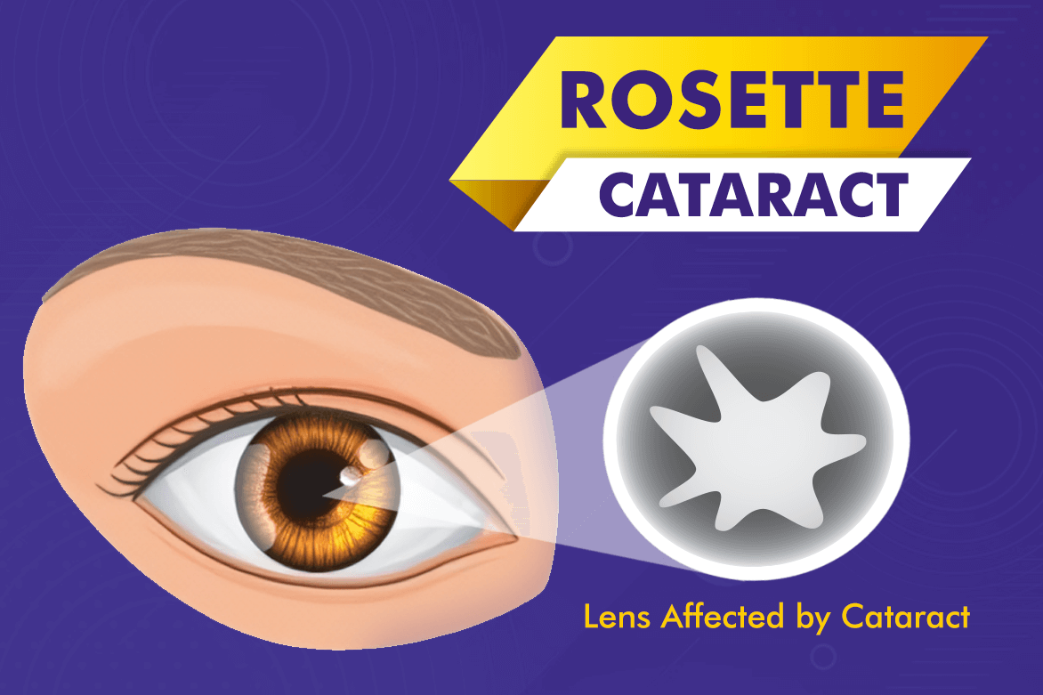 Rosette Cataract
