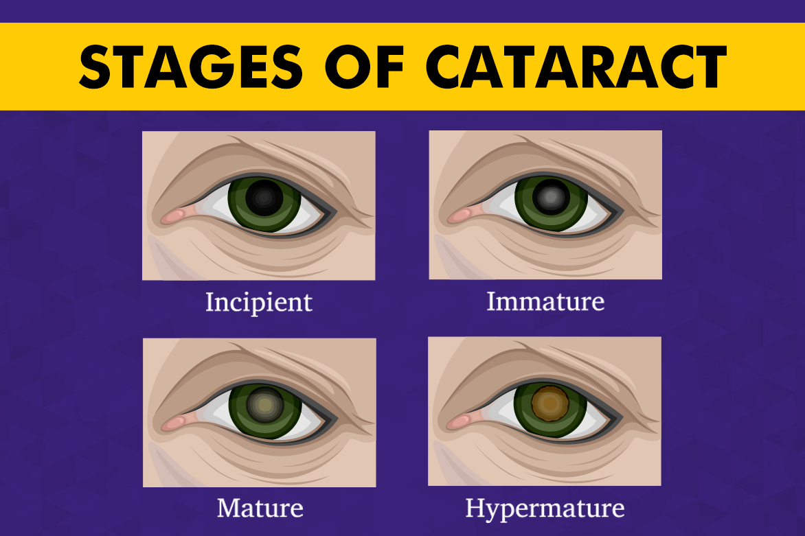 Cataract Grading