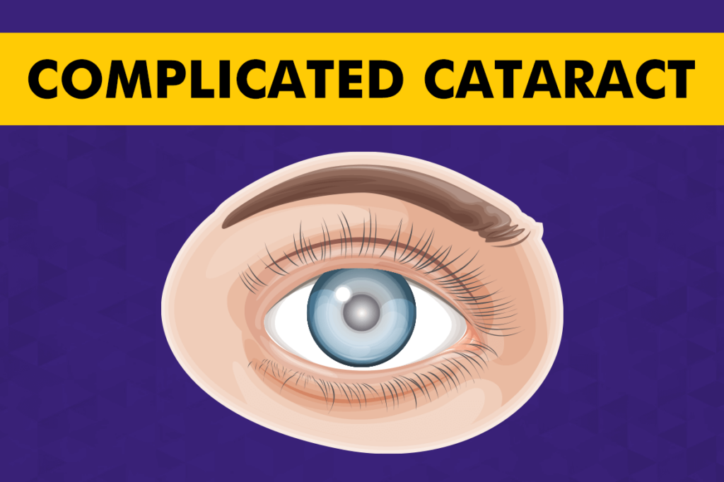 Complicated Cataract – Symptoms, Causes, Diagnosis & Treatment