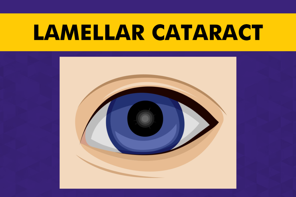 Lamellar Cataract (Zonular Cataract) – Meaning, Symptoms & Causes