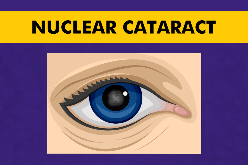 Nuclear Cataract
