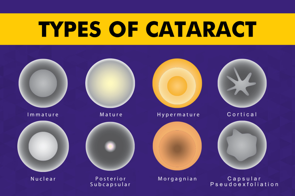 Types of Cataracts: A Comprehensive Guide
