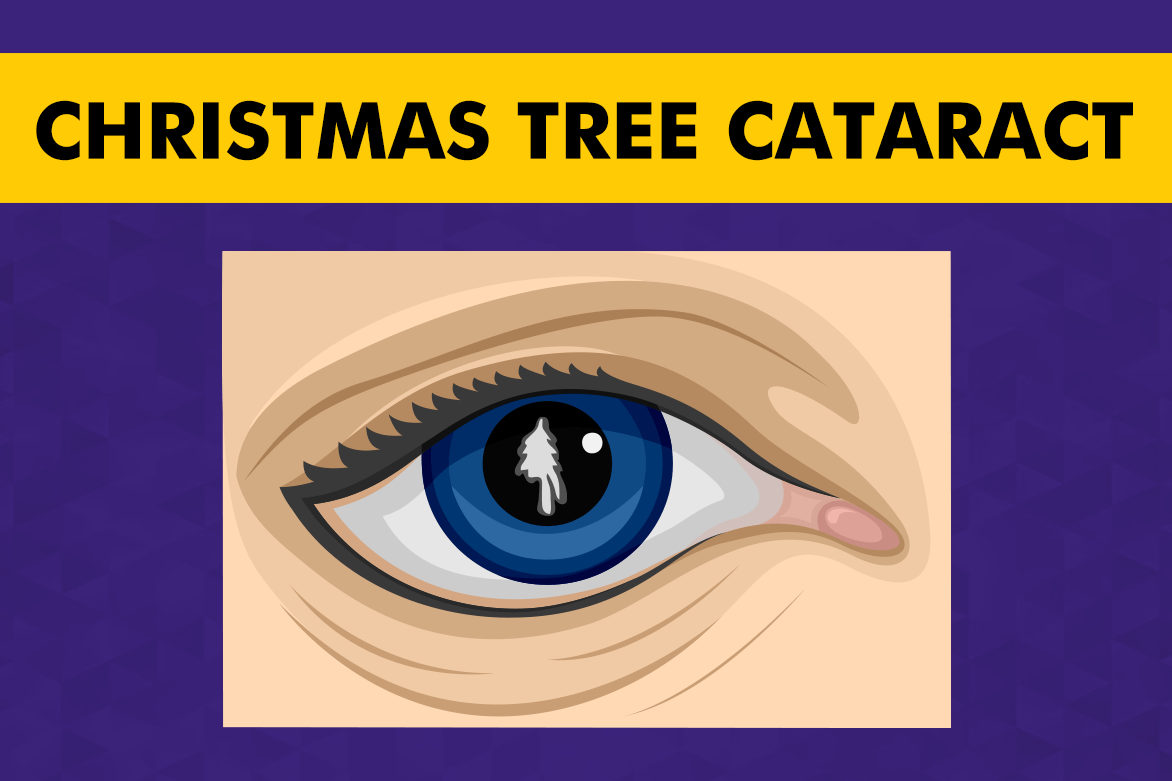 Christmas Tree Cataract