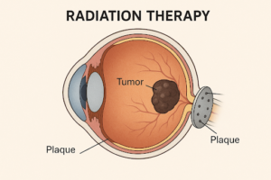 Radiation Therapy