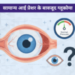 नॉर्मल टेंशन ग्लूकोमा