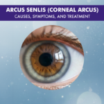 Arcus Senilis