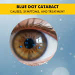 Blue Dot Cataract -Cerulean