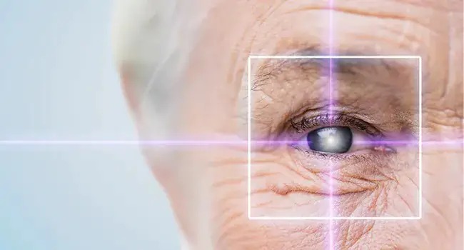 Cataract Surgery