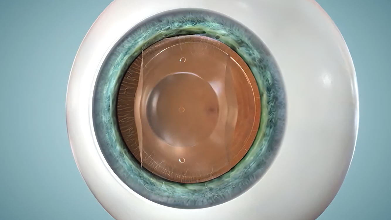 IPCL / Phakic IOLs / ICL (Implantable Collamer Lens) Surgery in New ...