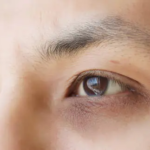 dark circles under eyes